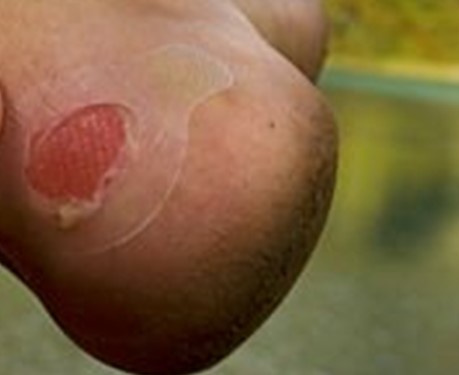 Ampolla o flictena